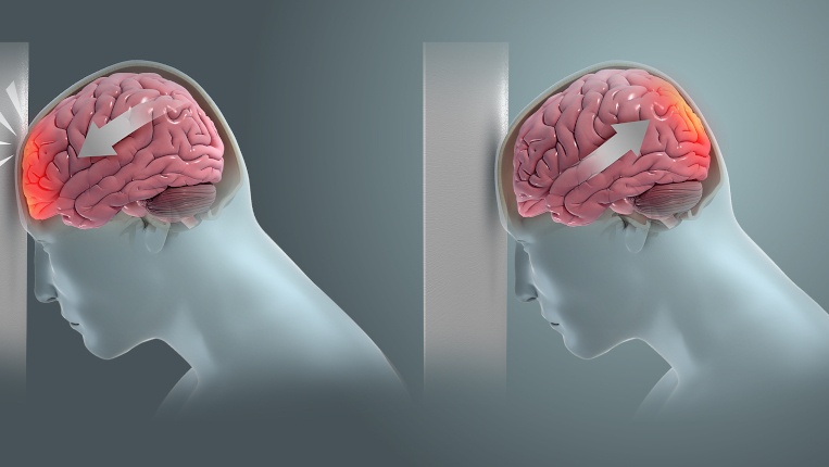 conmociones cerebrales