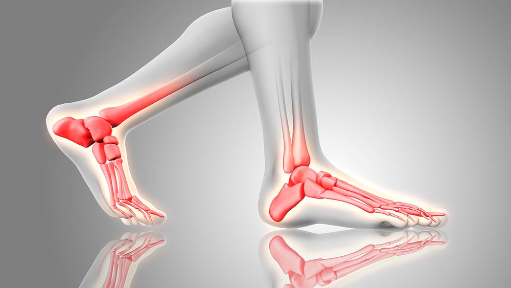 Fascitis plantar: cómo tratar y prevenir el dolor de talón