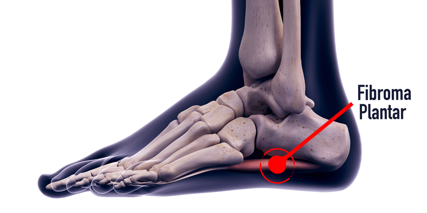 Revisión de los fibromas plantares