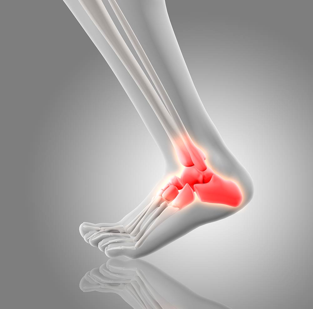 Ese dolor en la parte posterior del pie podría ser tendinitis de Aquiles