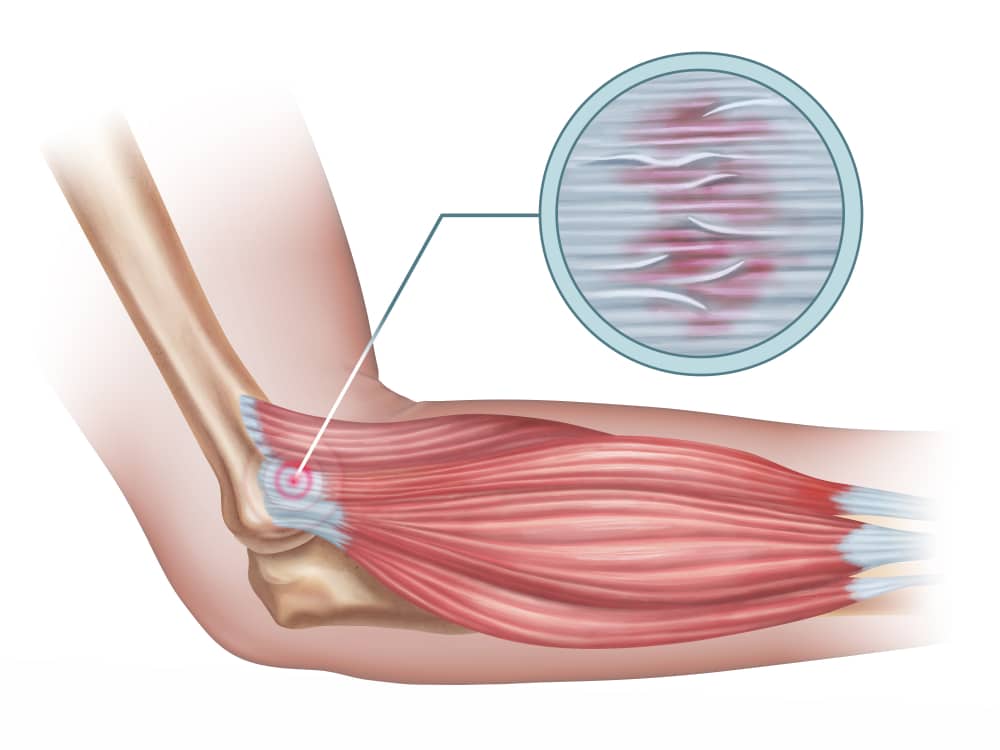 Tendinitis y Tendinosis: ¿Cuál es la diferencia?