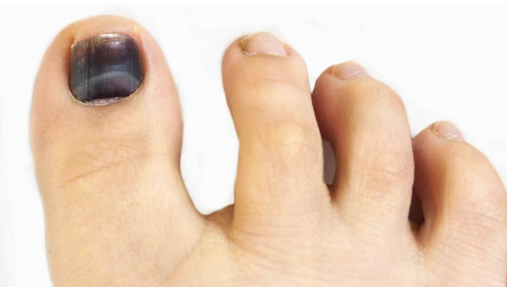 Cómo prevenir las uñas de los pies negras
