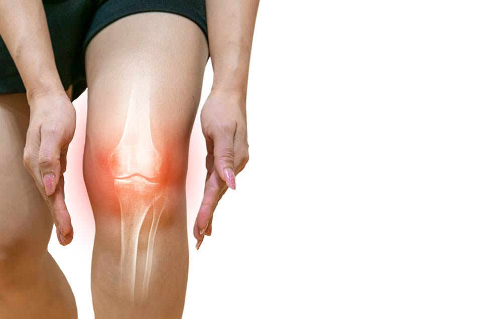 Lesión explicada: artritis de rodilla u osteoartritis (y cómo vivir con ella)