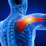 Beneficios de la rehabilitación del dolor de hombro