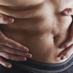 Diástasis de los rectos abdominales