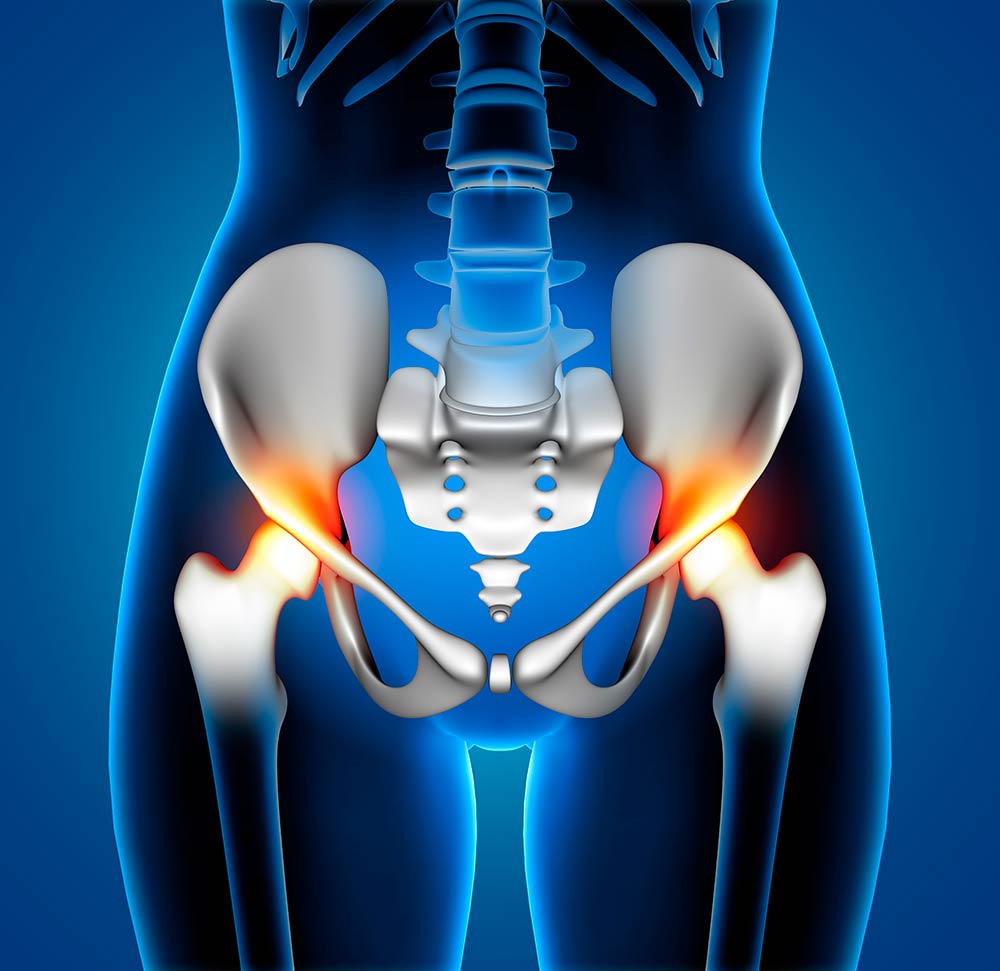 Dolor de cadera por correr: posibles causas