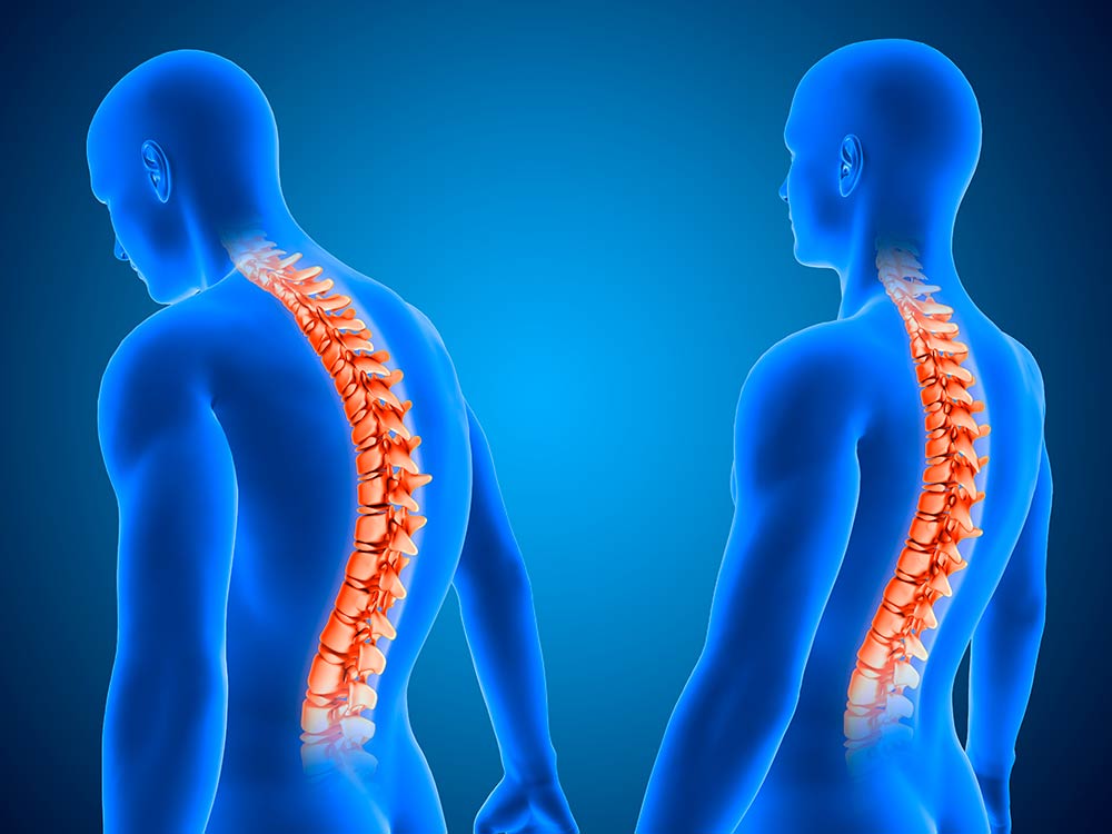 Escoliosis ¿La curvatura en mi columna vertebral está causando mi dolor de espalda?