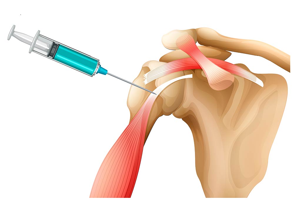 Inyecciones de ácido hialurónico para articulaciones y tendones: ¿Son útiles?