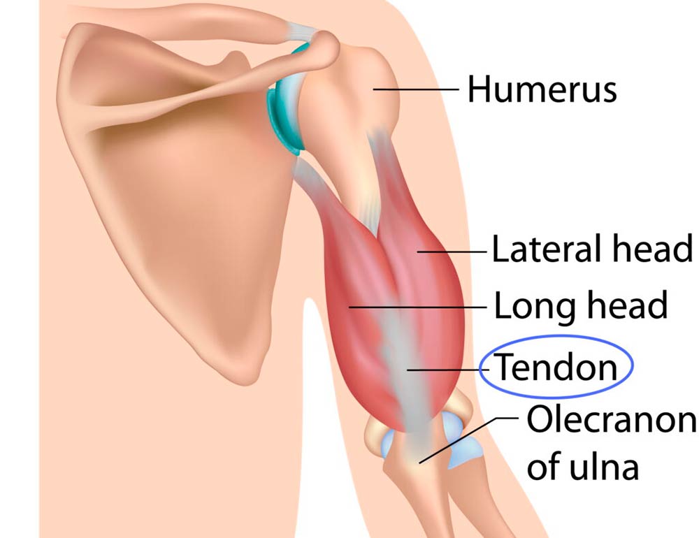Tendinitis del tríceps: el codo del levantador de pesas